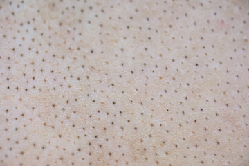 Skin with large pores and acne blackhead problems.