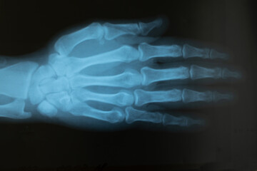 X-ray of the hand of an adult male with an injured finger. Selective focus. Blur. Noise, sharpness and grain are typical for X-rays. Horizontal orientation.