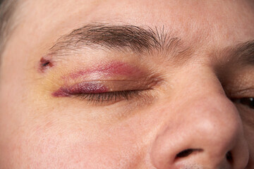 close view of a black eye, man's face with a hematoma