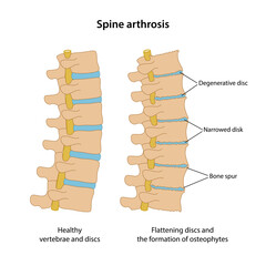 Spine arthrosis with main description. Healthy spine and spine with arthrosis in lateral view are isolated on white background. Vector illustration in flat style - obrazy, fototapety, plakaty