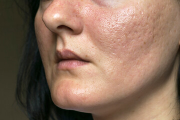Woman with problematic skin and acne scars. Pigmentation on face woman. Problem skin care and...