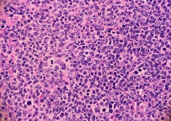 High grade follicular lymphoma with marginal zone differentiation. Multiple lymphocytes are...