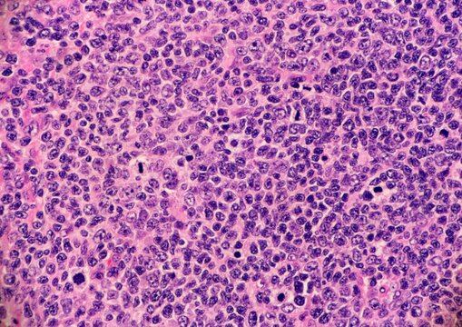 High grade follicular lymphoma with marginal zone differentiation. Multiple lymphocytes are undergoing mitosis. Microscopic view.