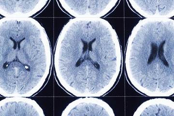 Closeup of computerized tomography of brain, xray film for doctor examination.