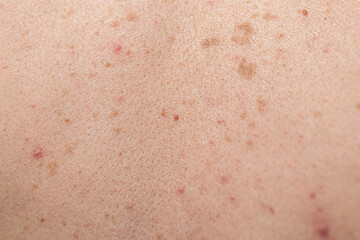 Fototapeta premium Close-up of large rashes or smallpox on the skin of an adult male. Pigmented spots on the back of a man. Skin of a man with moles. Acne.