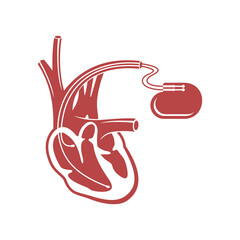 Pacemaker cardio stimulator flat icon (heart implant) - medical device scheme and human heart in sectional view - isolated monochrome silhouette illustration