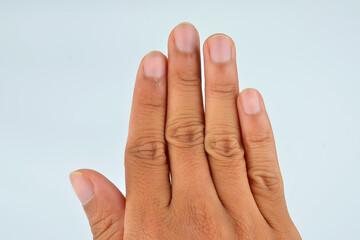 Finger with hangnail isolated on white background