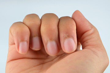 Finger with hangnail isolated on white background
