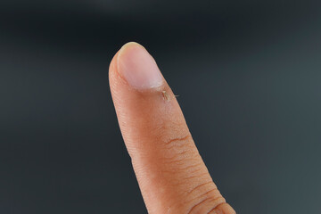Finger with hangnail isolated on black background.