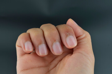 Finger with hangnail isolated on black background.