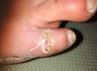 A close up of a diseased foot healing after toe and foot surgery. Surgical wounds, stitches and incisions post operation. Orthopaedic foot surgery. Toe bunion surgical procedure.