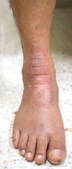 A physical of Atopic dermatitis (AD ) dry hyperpigmented cracked plaque skin  at akle area both leg, also known as atopic eczema, is a type of inflammation of the skin (dermatitis)
