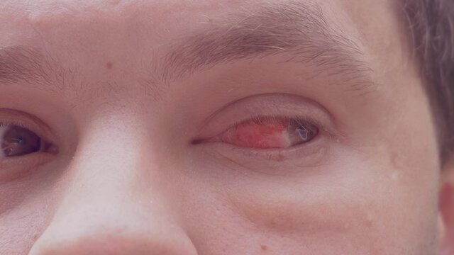Close up. man eye with chemical burns of the cornea. burst capillaries. Red sore eye, looking in different directions