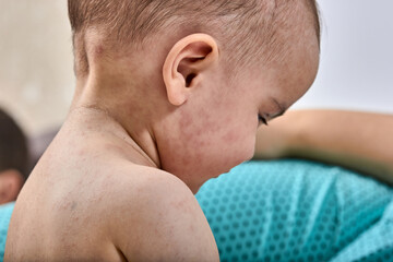 Obraz premium roseola rash a viral rash on the skin of a child