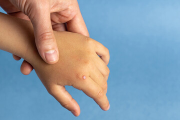 Common wart on the finger of a child’s hand - obrazy, fototapety, plakaty