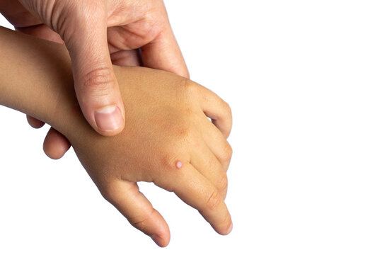 Children hand with warts