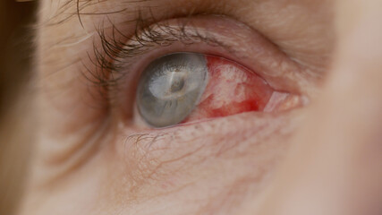 close up. woman eye with chemical burns of the cornea. burst capillaries, cataract surgery. - obrazy, fototapety, plakaty