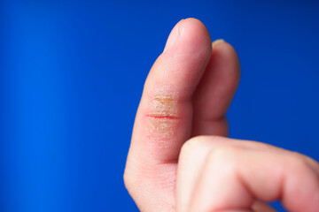 Cracks in the bends of the finger from the frequent use of a disinfectant. Dry cracked skin of finger of hand, eczema