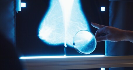  Breast cancer prevention. Doctor examines mammogram snapshot of breast of female patient on the...