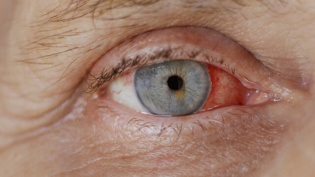 close up. woman eye with burst capillaries, cataract surgery.