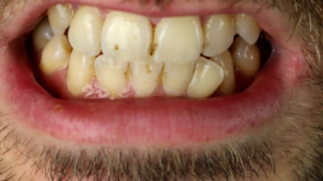 Smokers Tobacco Stained Teeth 