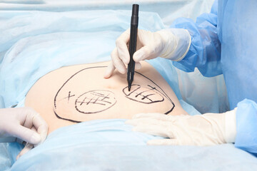 Surgery room. Belly surgery. Doctor mark liposuction area at tummy. Drawing at skin. Anti cellulite equipment. Copy space. Light blue color. Fat abdomen. Hostipal doctor hands