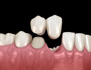 Cantilever bridge made from ceramic, frontal tooth recovery. Medically accurate 3D animation of dental concept