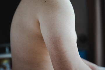 Keratosis Pilaris (KP) a skin problem on upper arm