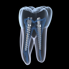 Dental steel post inside molar teeth, Xray view. Dental endodontic treatment 3D illustration