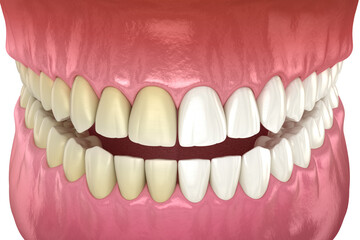 Teeth whitening - before and after. Dental concept, 3D illustration