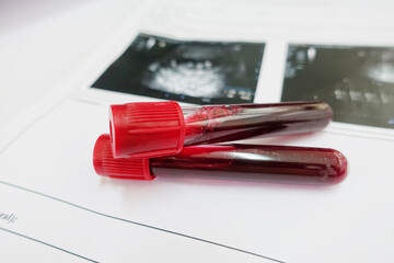 Blood for chromosome testing in Laboratory 