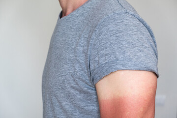 man in a gray t-shirt with a sunburned hand. visible light and red sunburnt skin. UV protection, sunscreen, sunblock.
