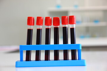 blood sample tube from patient in laboratory.