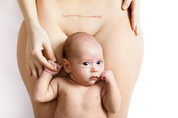 Newborn baby and his mother with a scar after C-Section on her belly - obrazy, fototapety, plakaty