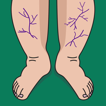 Varicose veins on legs of woman