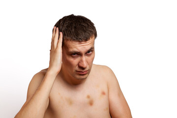 Fototapeta premium A brown-haired man of European appearance on a white background in a photo studio with a naked torso covered with bruises holds his hand on his head. Anesthetic advertising.