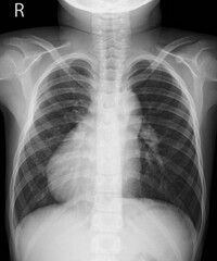 Chest X-ray of a 11 year old young boy with dextrocardia situs inversus showing the cardiac apex...