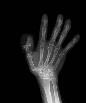 X-ray image of right hand, posteroanterior viwe(PA),  showing tumd bone fracture.