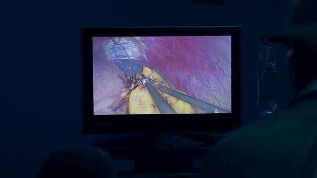 Surgeon performing laparoscopic surgery. Laparoscopic surgery on the monitor. Surgeons perform an operation and look at the screen  in the operating room. Modern technologies in medicine.