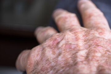 Lesions of actinic keratosis or sunspots on sun-damaged skin of the hand of a man. This can be treated with cryosurgery or certain ointments