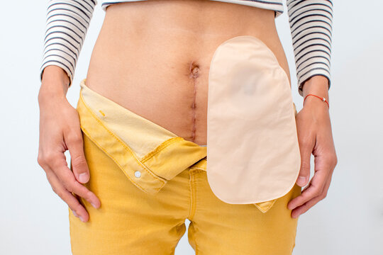 full colostomy bag with velcro closure