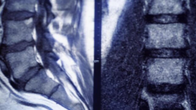 Macro panorama of MRI of lumbar spine with osteochondrosis, age-related changes in discs of vertebrae and pinched nerves