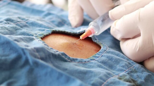 Applying anesthesia around lipoma in man's back for ambulatory surgery in selective focus