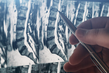 Doctor examines MRI of lumbar spine with pinched discs of spine and nerves, points at problem areas...