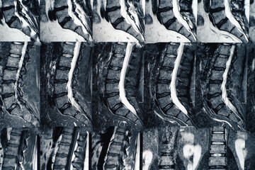 Macro photo of MRI of lumbar spine with osteochondrosis, age-related changes in discs of vertebrae...