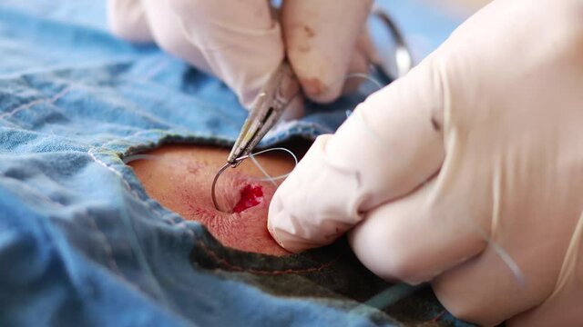 Sewing wound in man's back after ambulatory surgery in selective focus