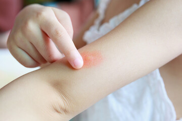 Obraz na płótnie Canvas Little girl has skin rash and allergy from mosquito bite