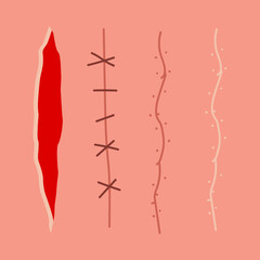 Scar, wound, incision, suture vector set isolated on background.
