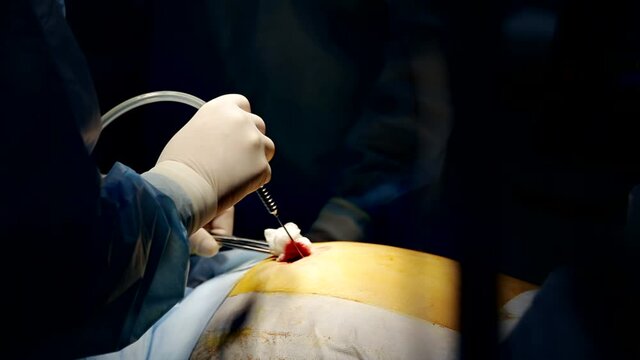 Hands of doctor conducting laparoscopic surgery