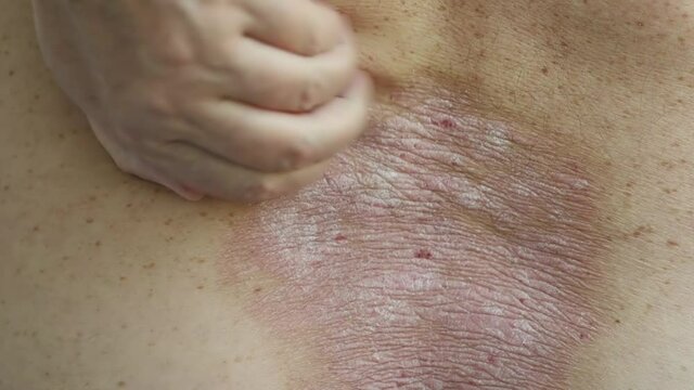 psoriasis: a close-up of a man running his hand over an area of the back affected by psoriatic rashes and plaques